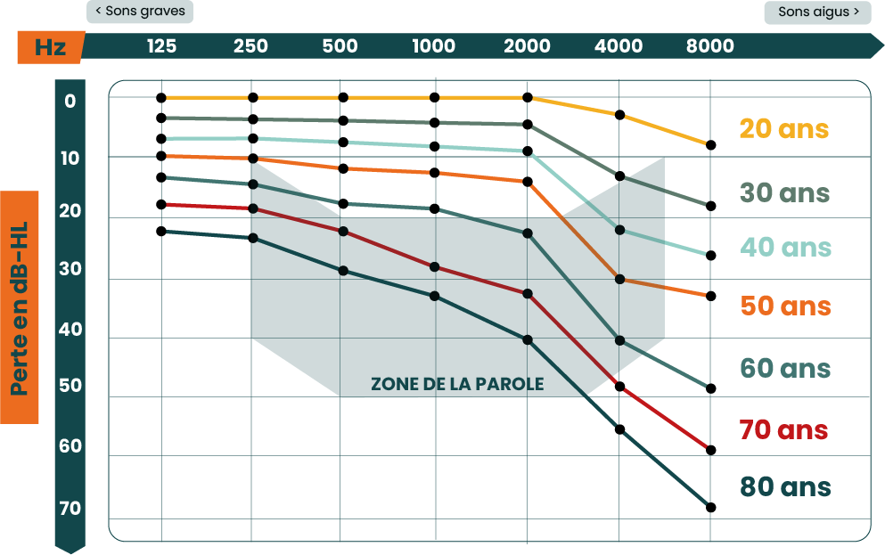 Graphique de perte auditive qui représente les Hz et la perte en dB-HL sur un graphique allant de 20 ans à 80 ans.